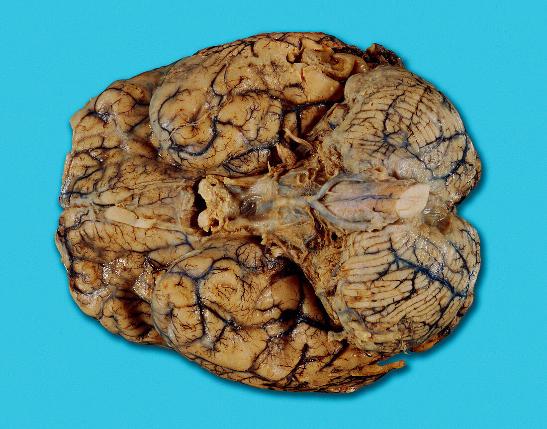 Brain with meningitis