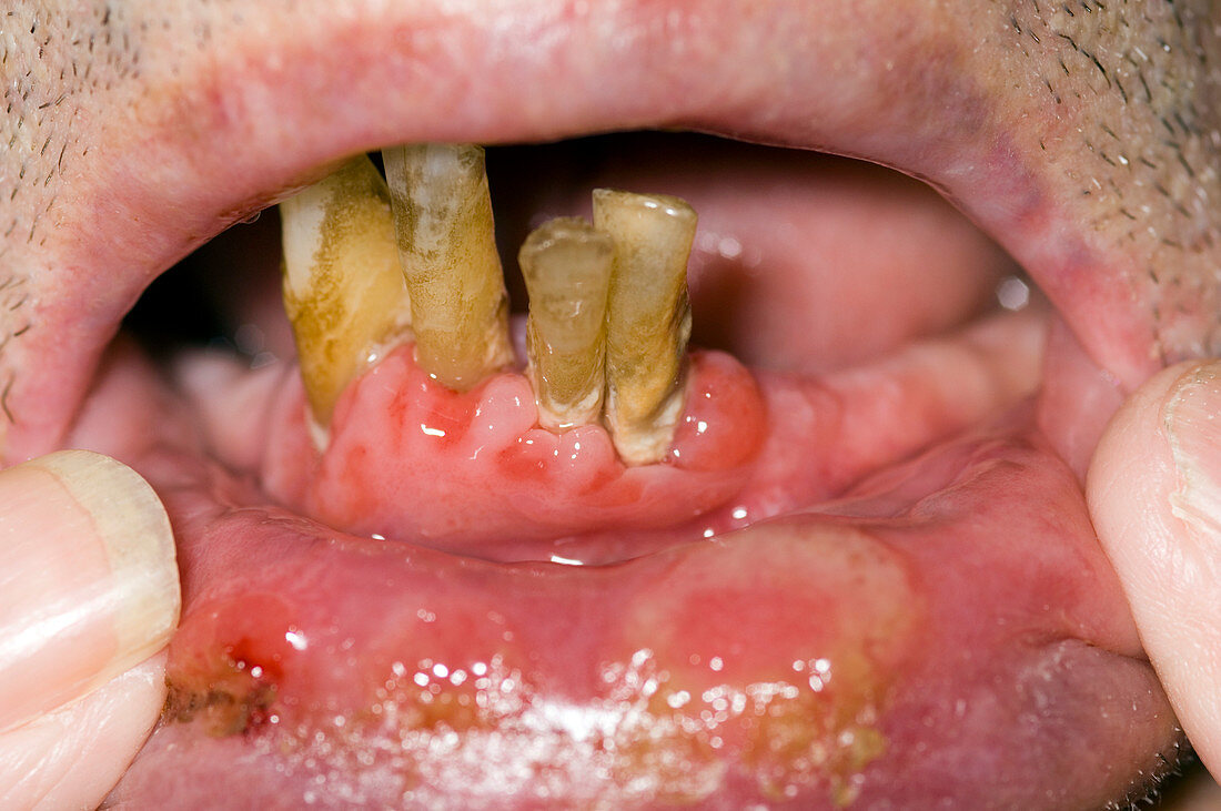 Mouth ulcers from myelodysplasia