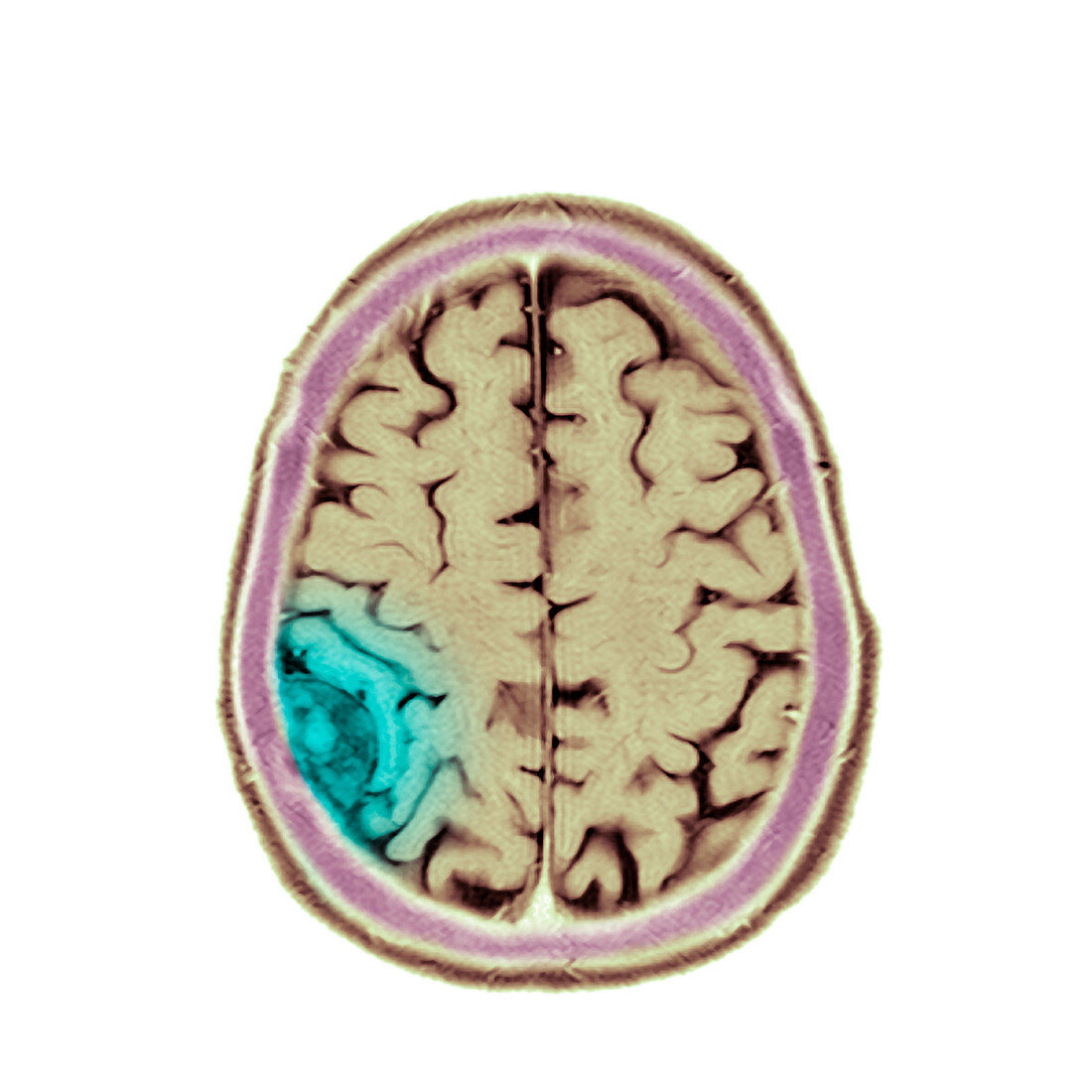 Meningioma tumour,MRI scan