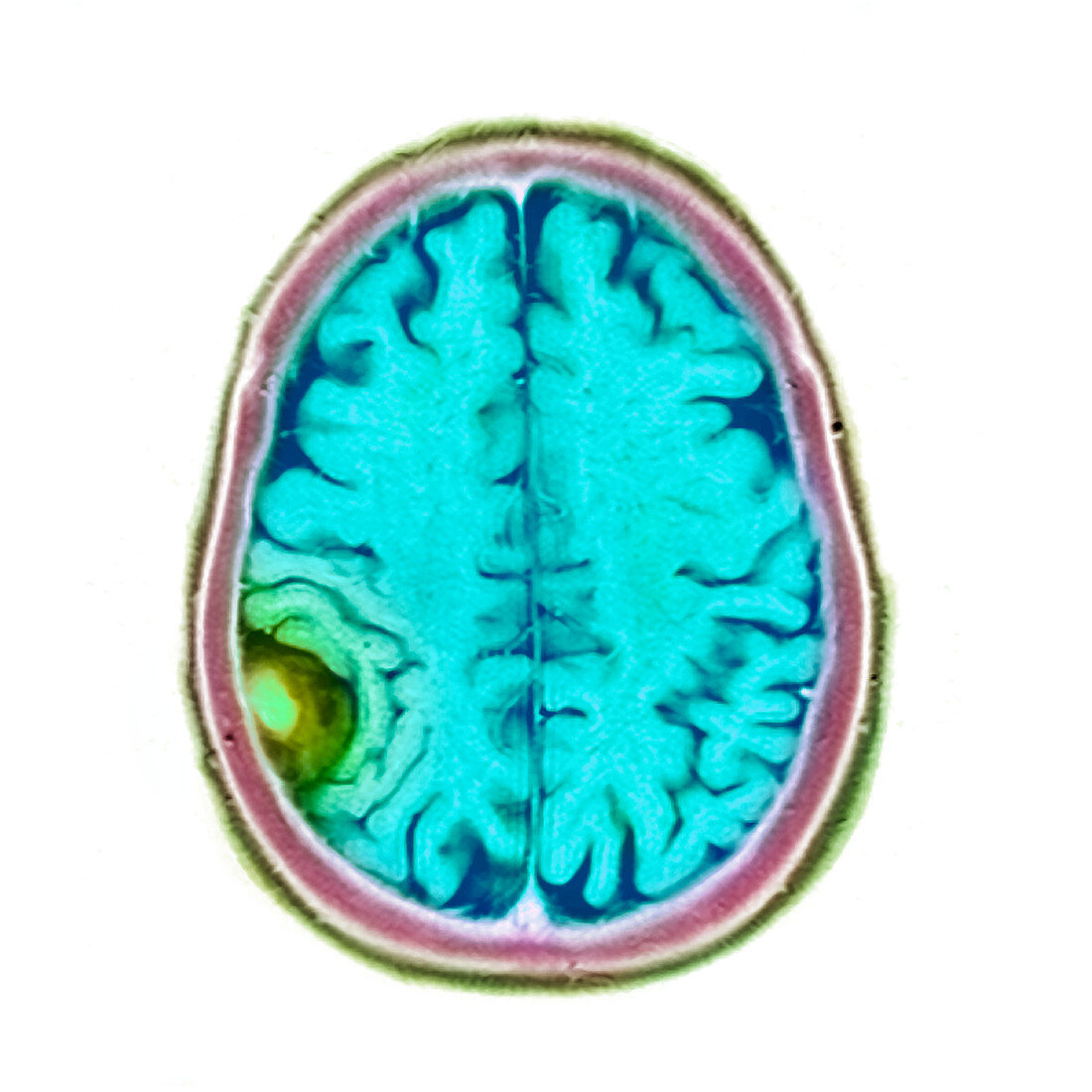 Meningioma tumour,MRI scan