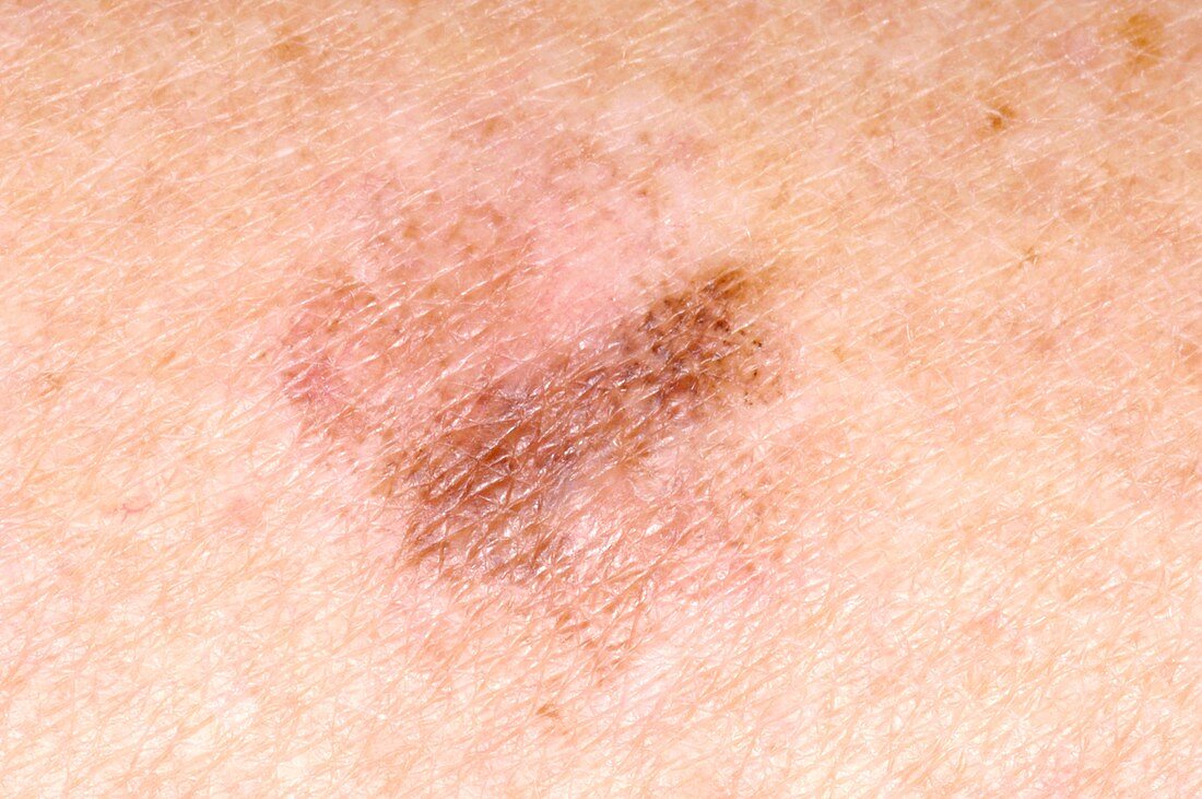 Precancerous skin lesion on thigh