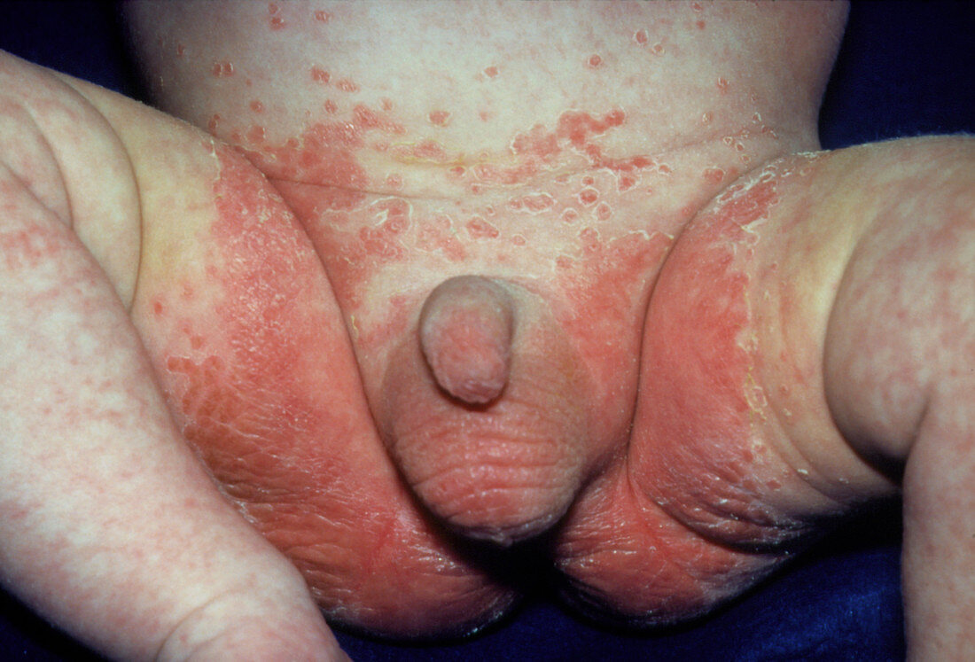 Severe nappy rash on young infant