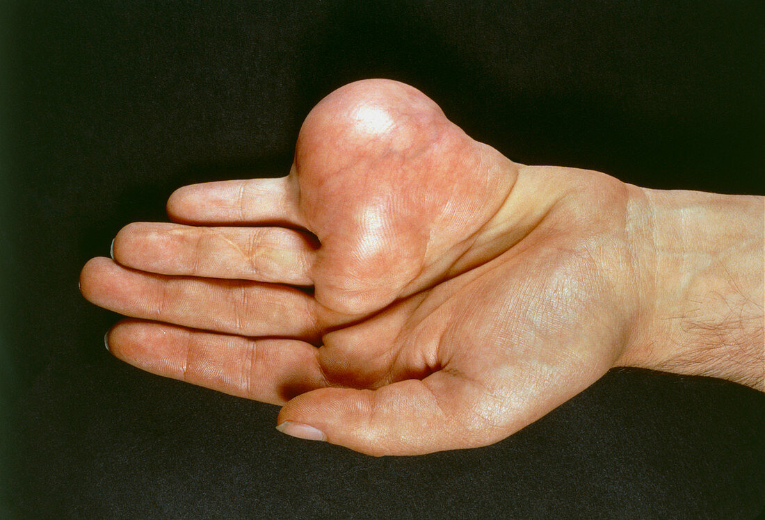 Large neurofibroma on a man's hand
