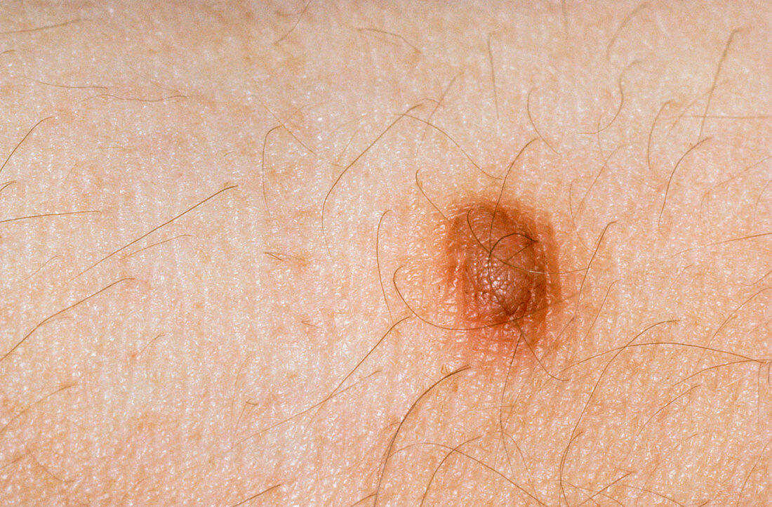 A dermatofibroma,type of mole in the skin