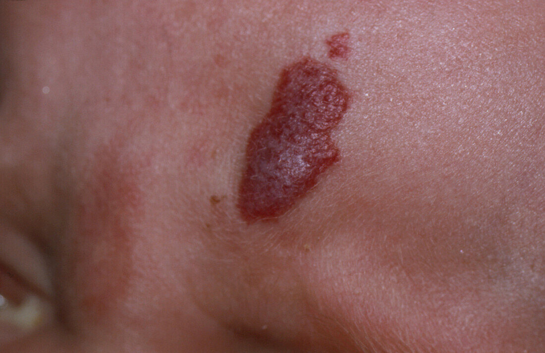Strawberry naevus on forehead of baby
