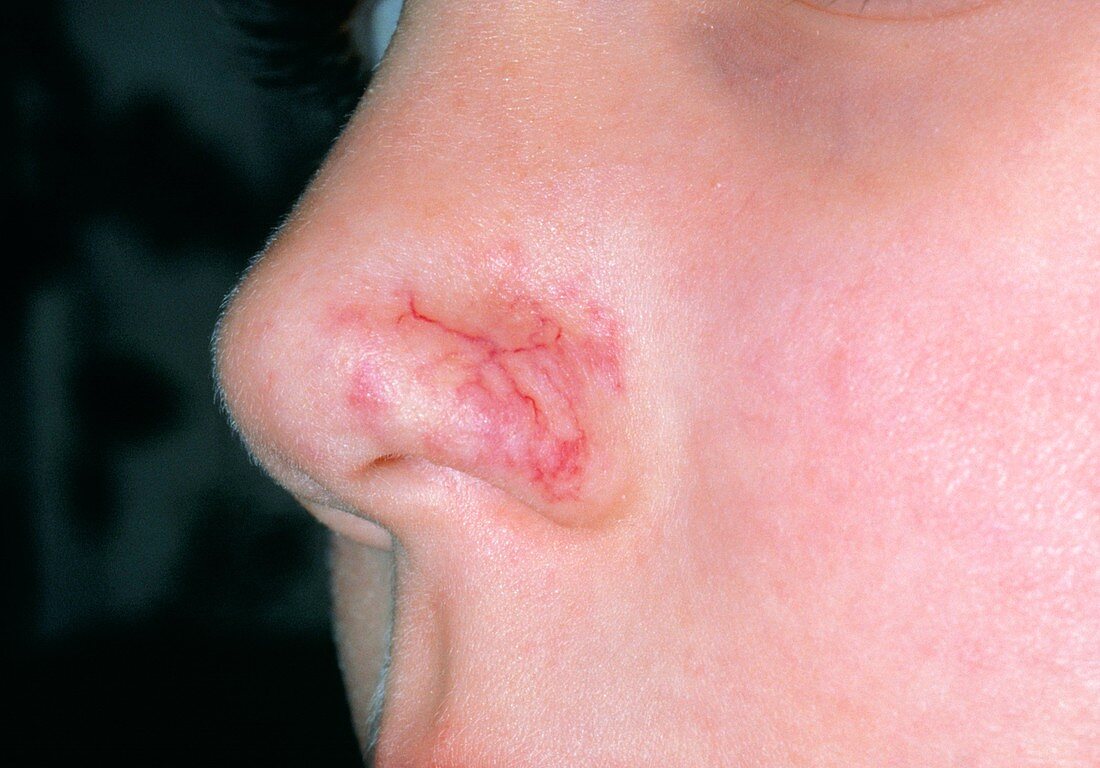 A vascular naevus on the nose of a child