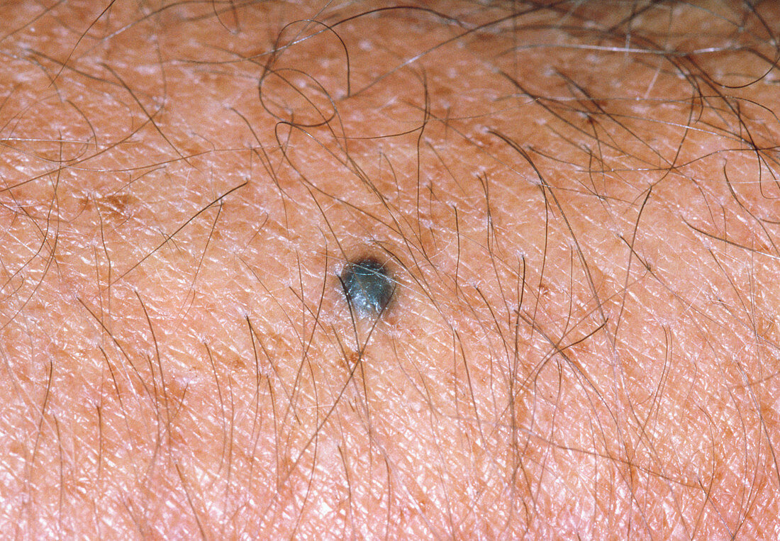 A blue naevus,a type of birthmark