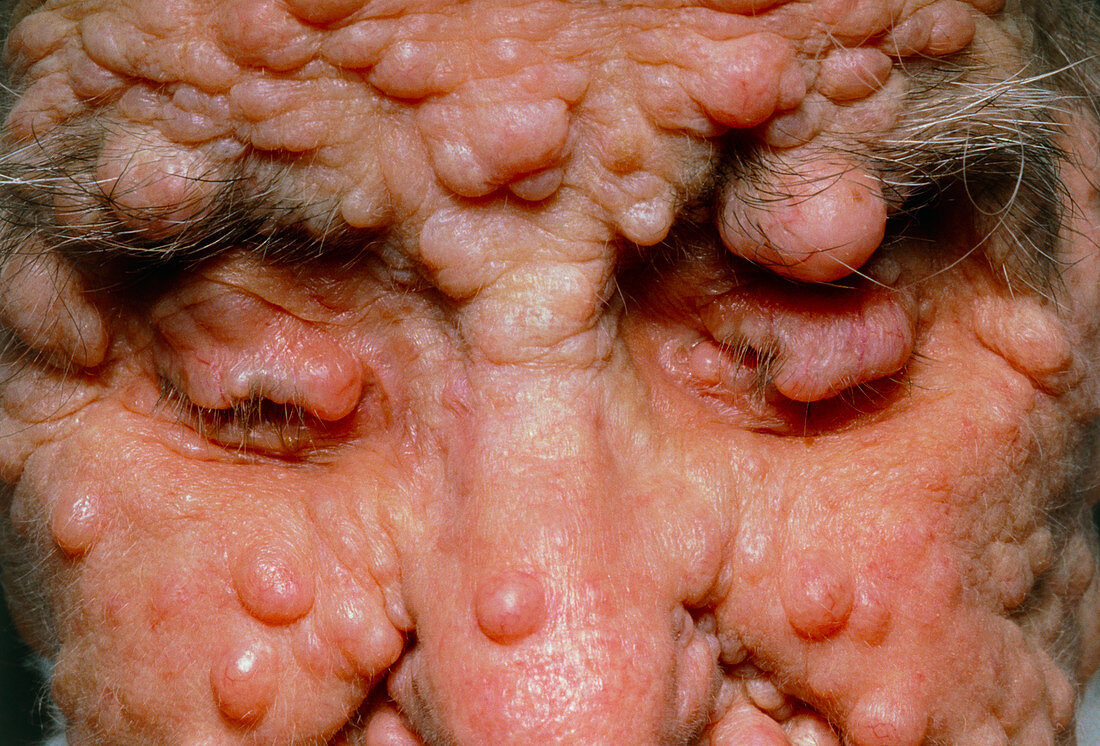 Woman's face with neurofibromatosis