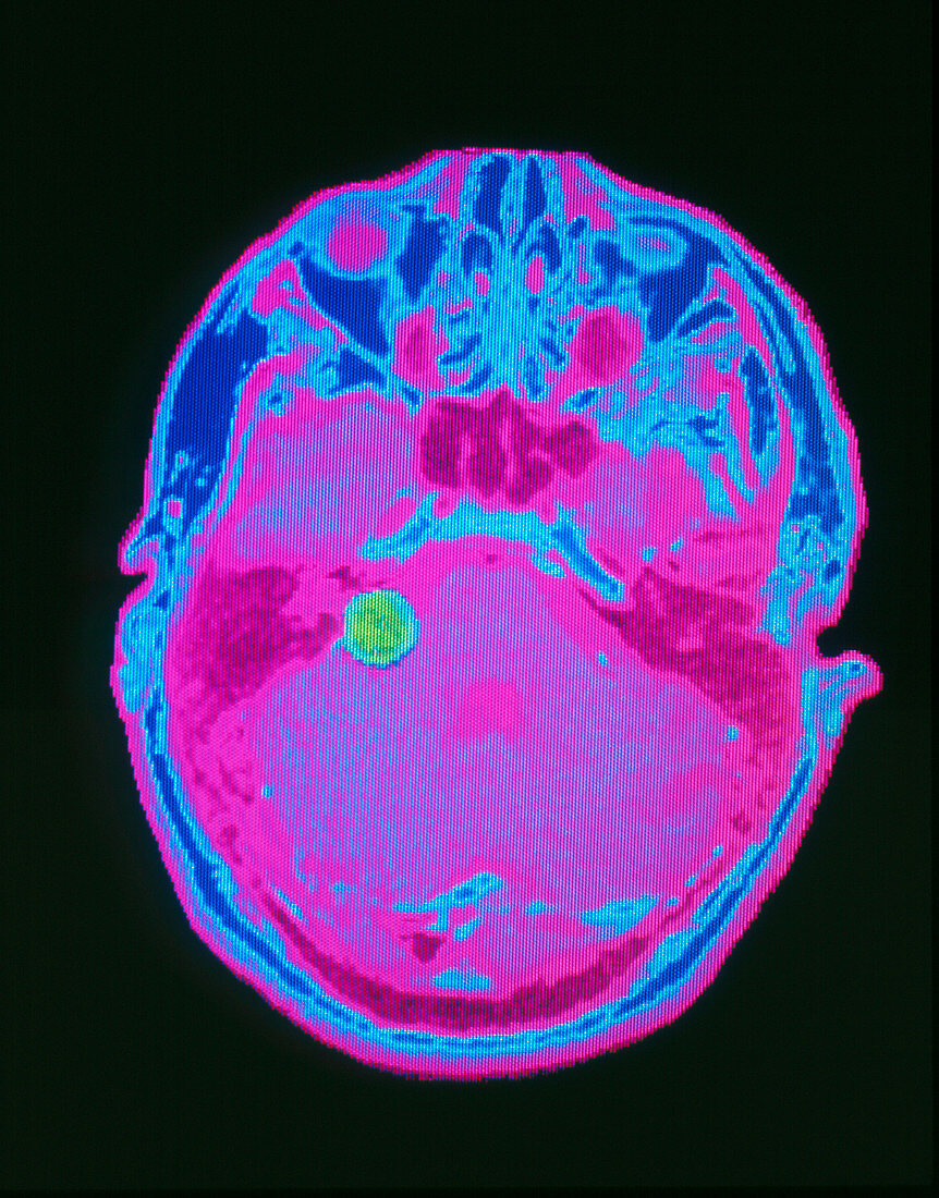 False-colour axial MRI scan: acoustic neuroma