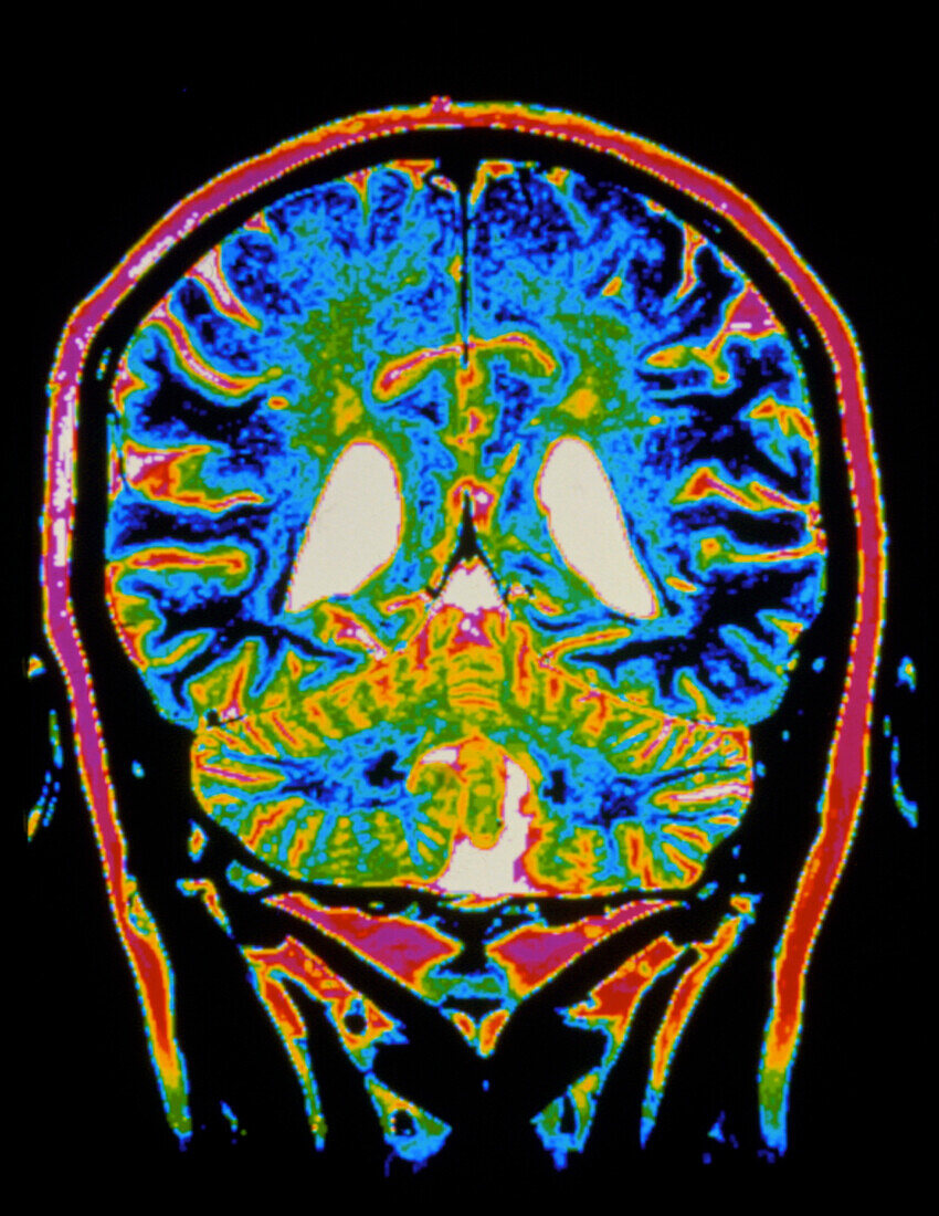 Colour MRI scan of a brain with multiple sclerosis