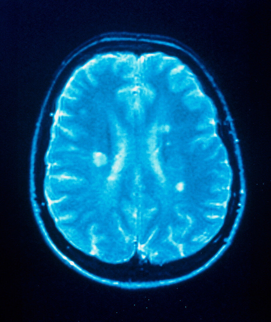 Multiple sclerosis,MRI brain scan