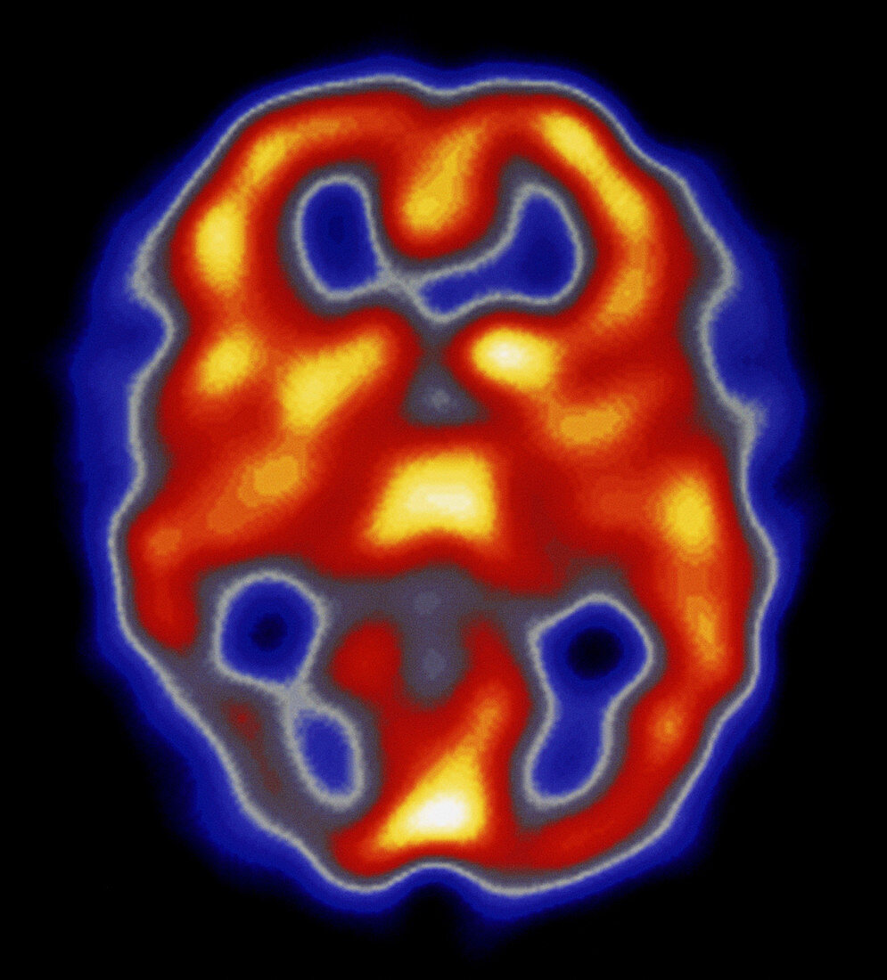 Colour SPECT scan of brain during migraine attack
