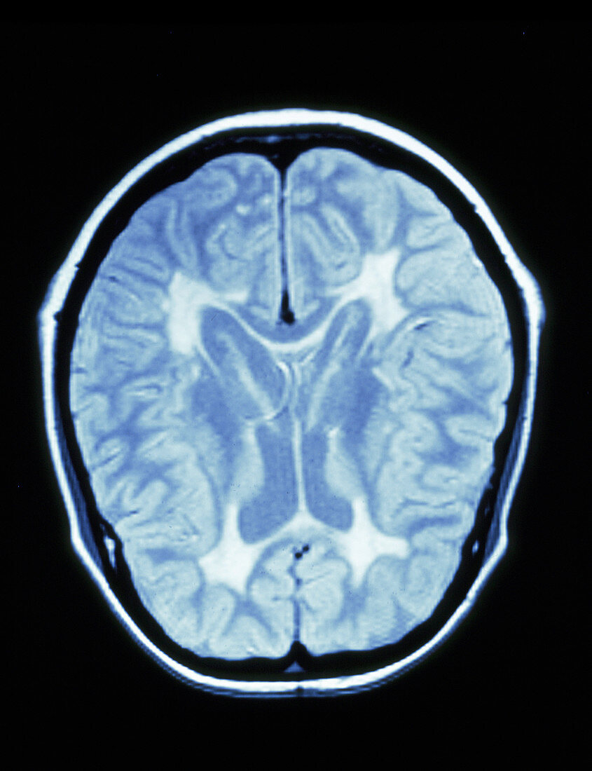 MRI scan of a brain with multiple sclerosis
