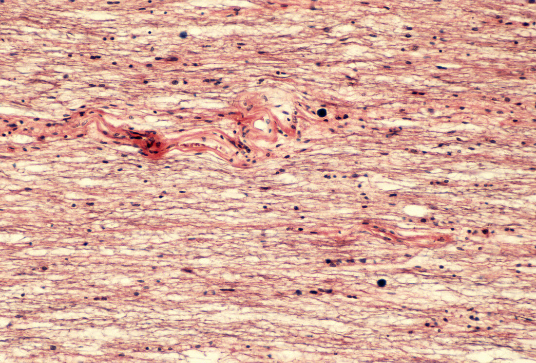 LM of multiple sclerosis lesion in spinal cord