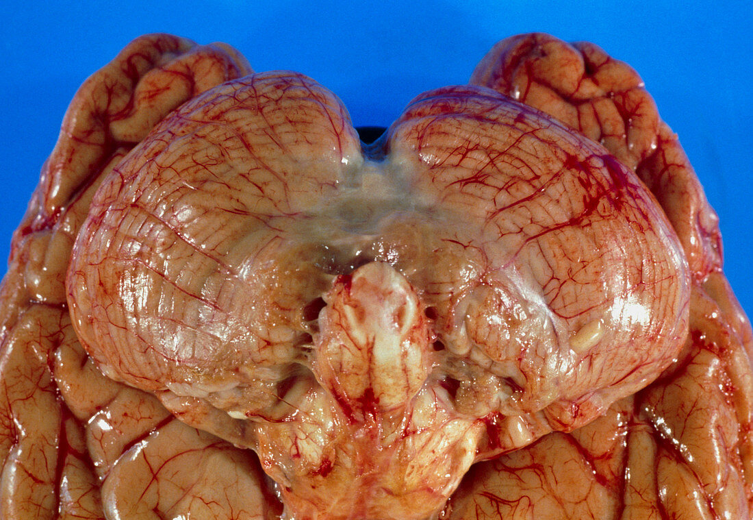 View of undersurface of brain with meningitis