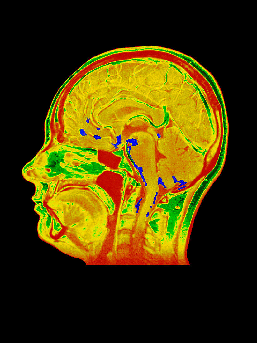 Coloured MRI scan of human brain with meningitis