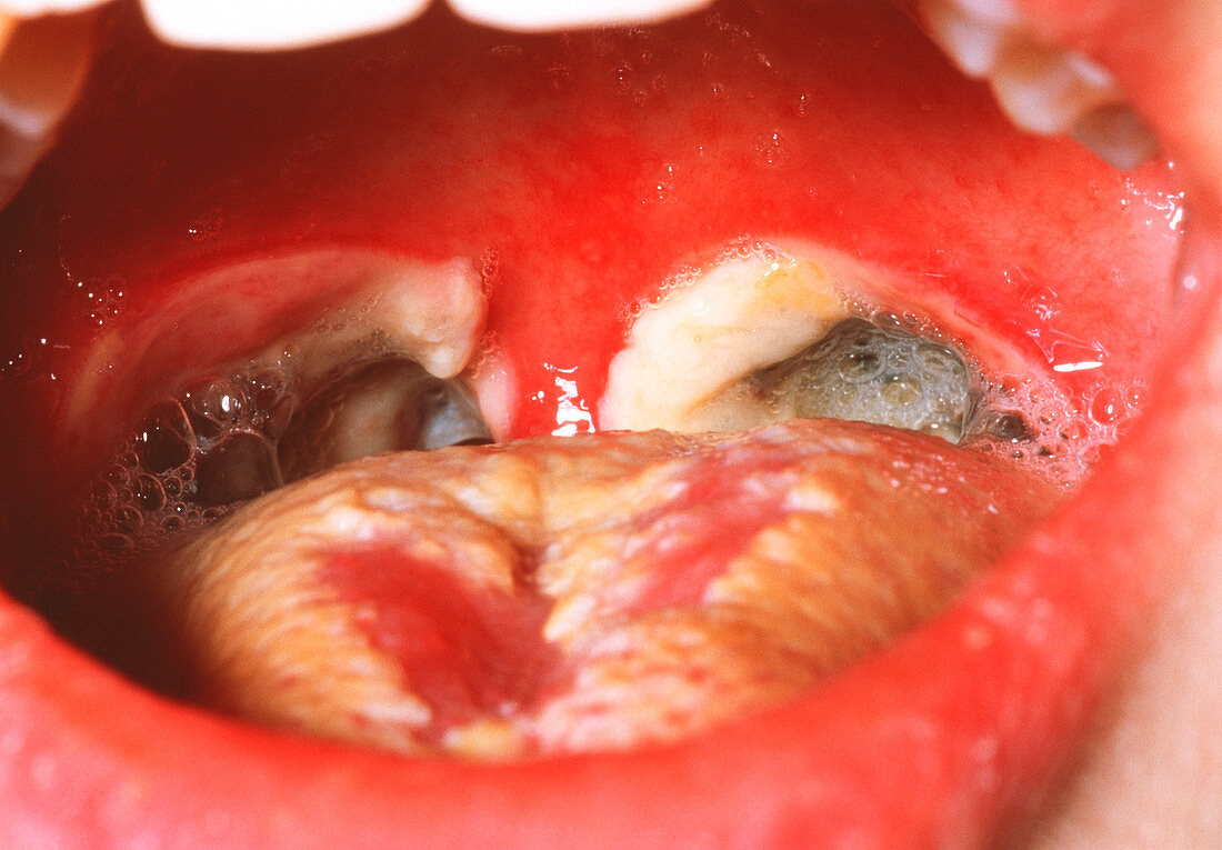 Oral infection