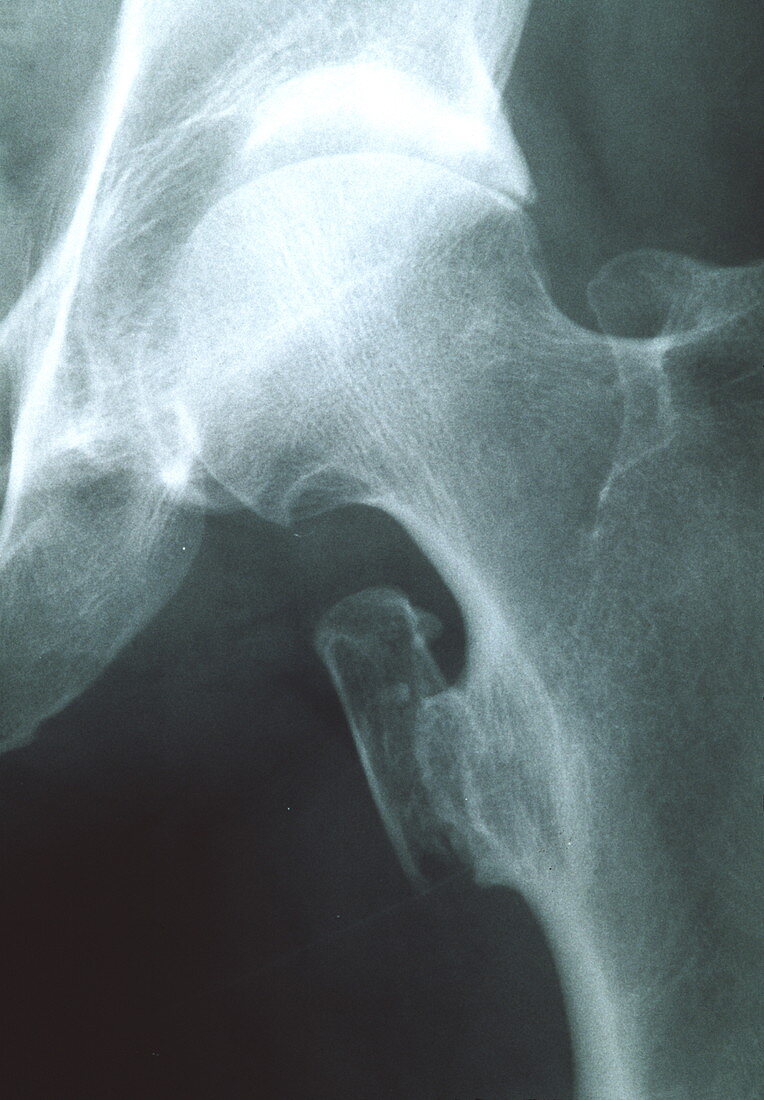 Abnormal bone growth,X-ray