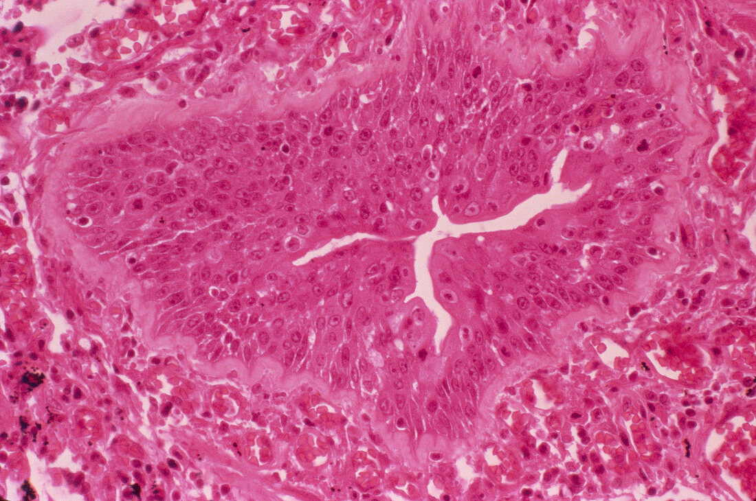 Lung metaplasia,light micrograph