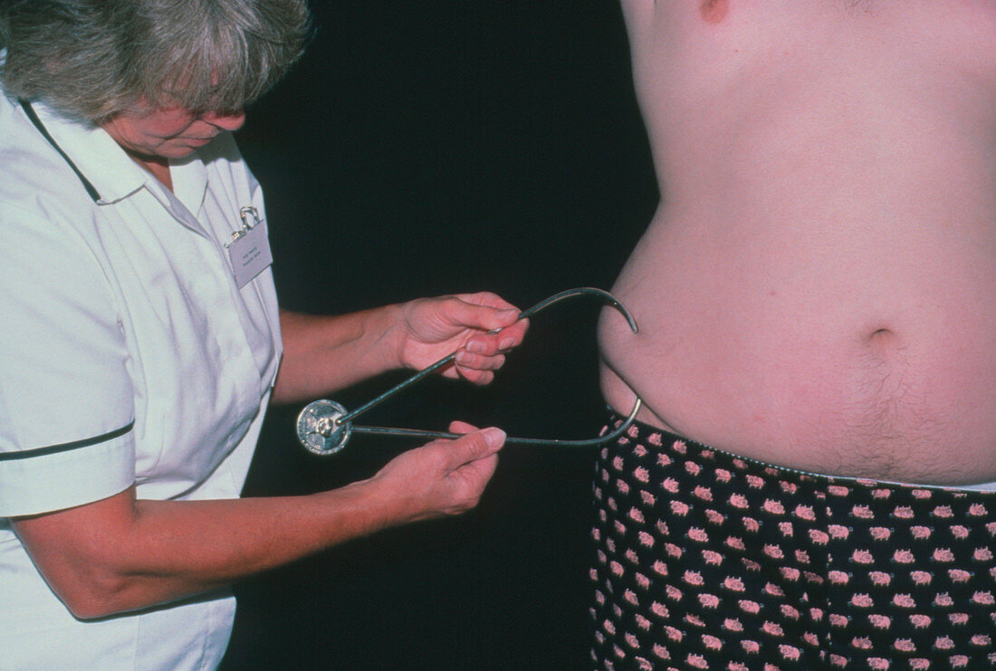 Fat measurement of obese man with callipers