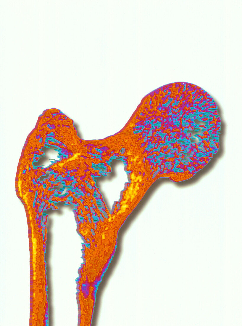 Coloured X-ray of thigh bone with osteoporosis