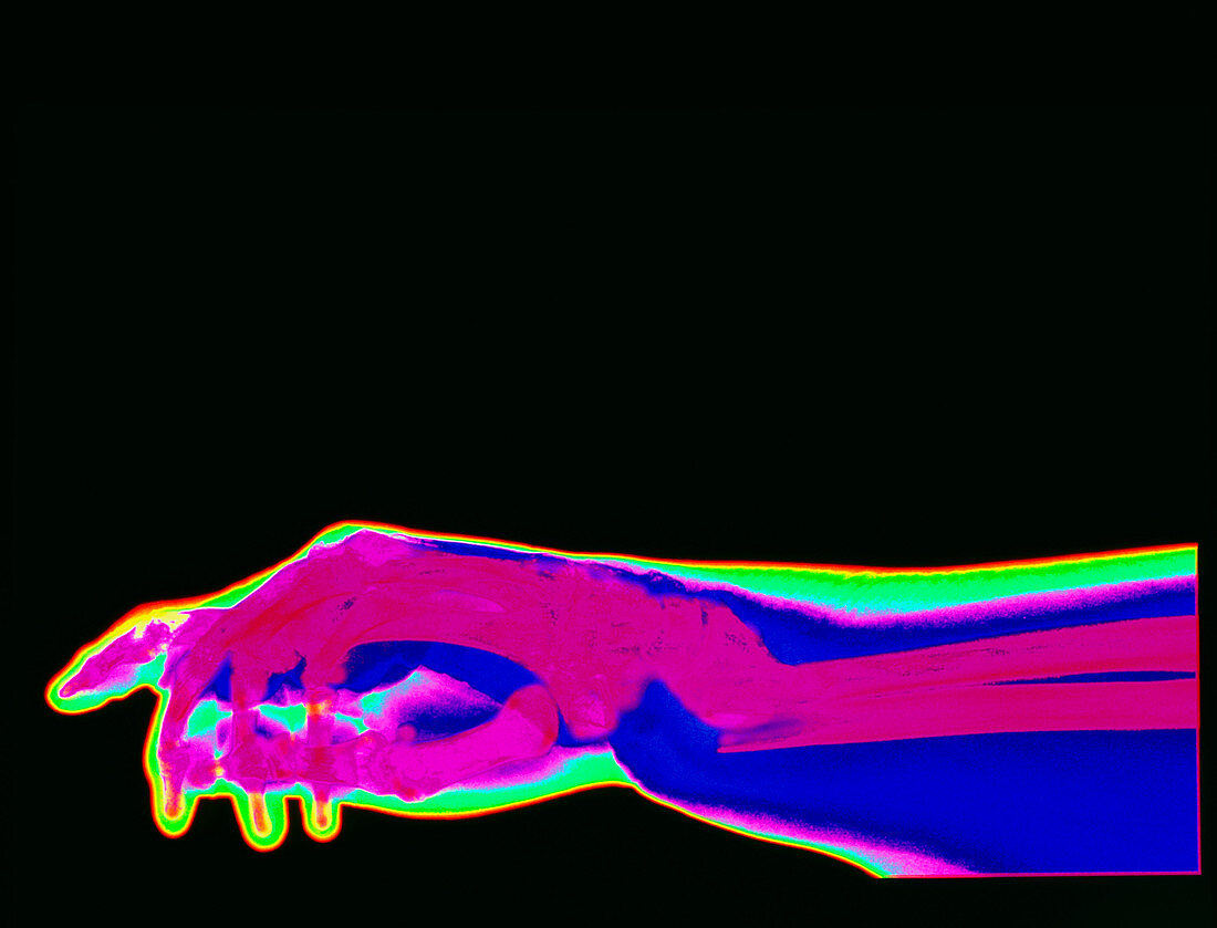Coloured X-ray of Colles' fracture in osteoporosis