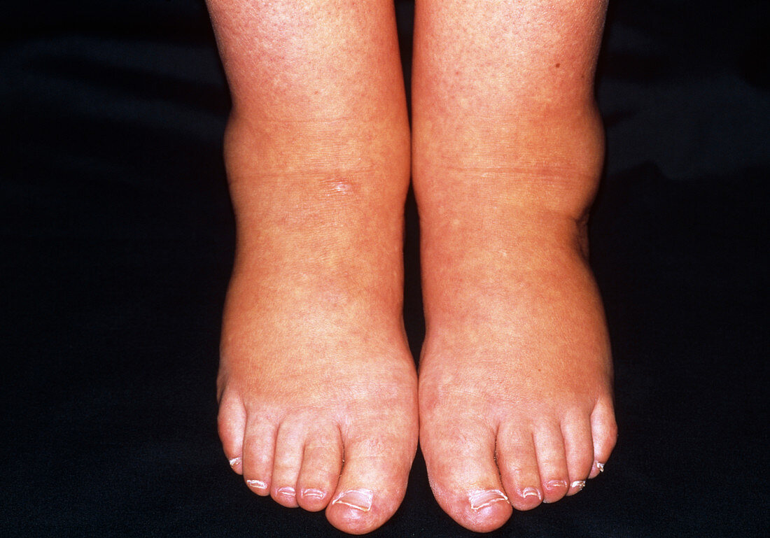 Ankle oedema showing swelling