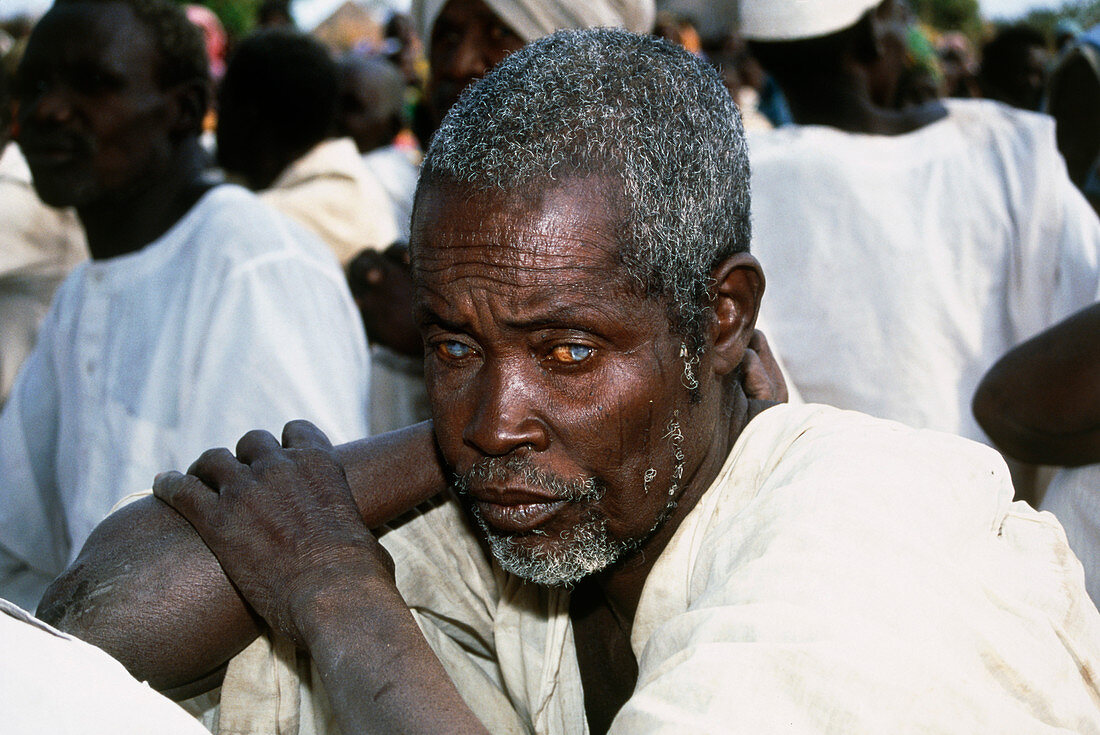 Man with river blindness
