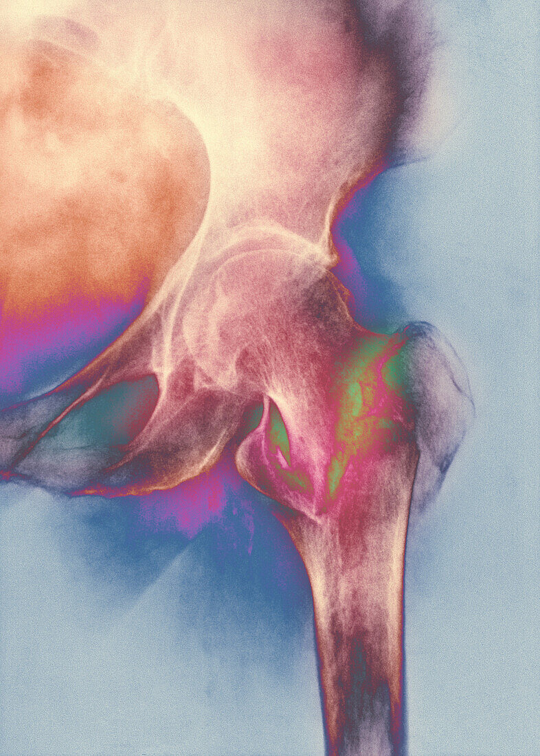 Coloured X-ray of femur fracture in osteoporosis