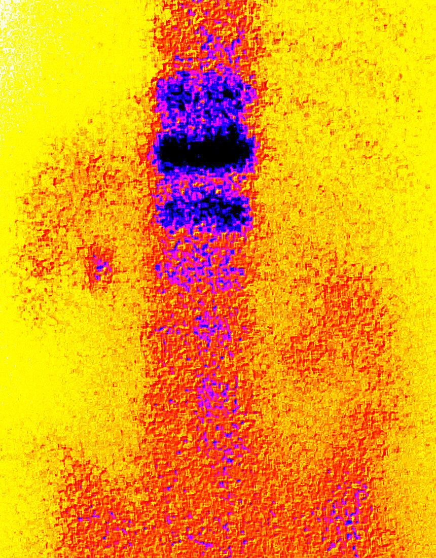 Coloured gamma scan of osteoporosis in vertebra