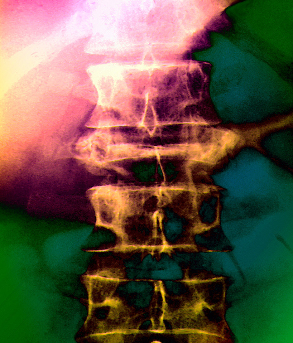 Osteoporosis of spine,X-ray