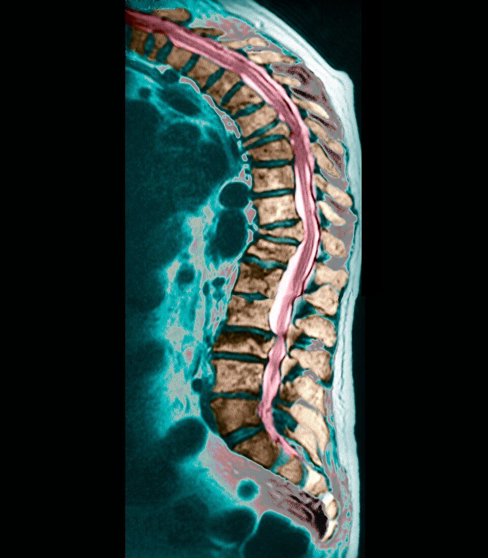 Spinal osteoporosis,MRI scan