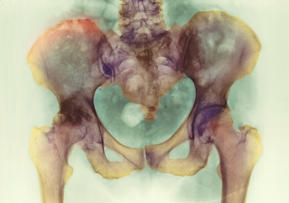 Bone death,X-ray