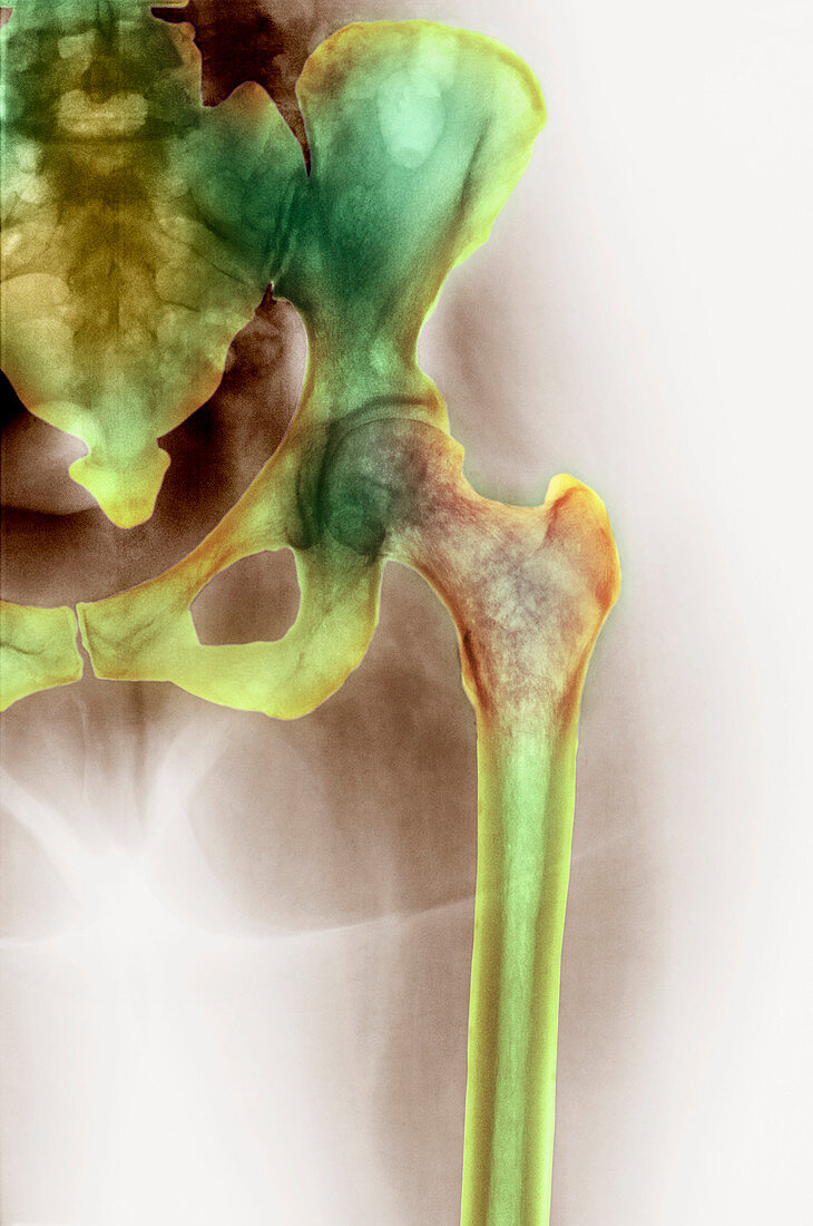 Osteoporosis of the hip,X-ray