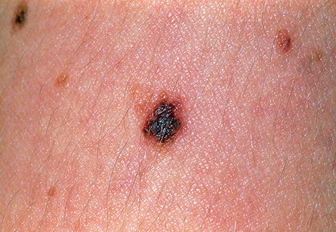 Benign melanocytic naevus (mole) on the skin