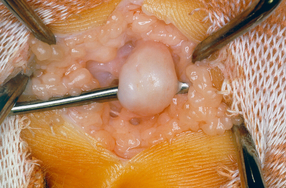 Gross specimen of a neuroma from a patient's digit