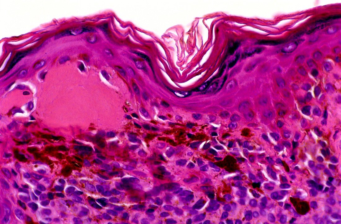 LM of a compound naevus or skin mole