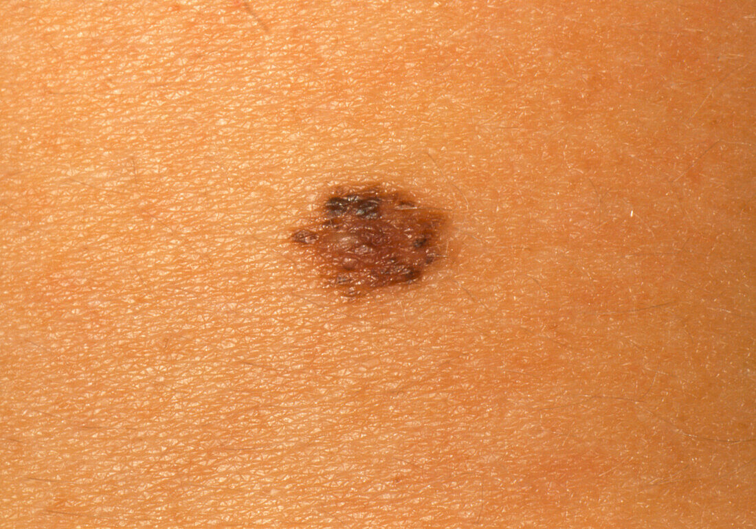Close-up of a compound naevus or skin mole