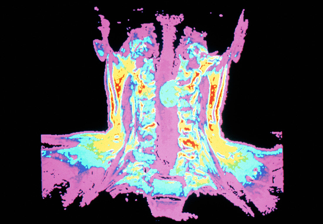 Spinal neurofibroma,MRI scan