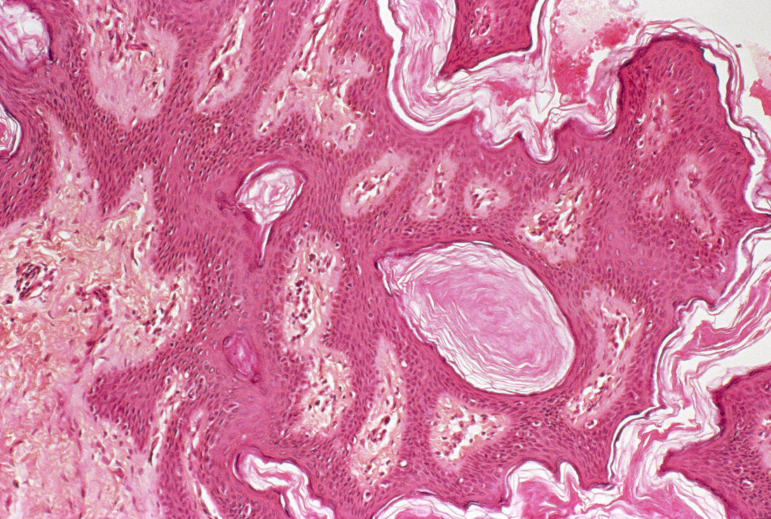 Warty skin mole,micrograph