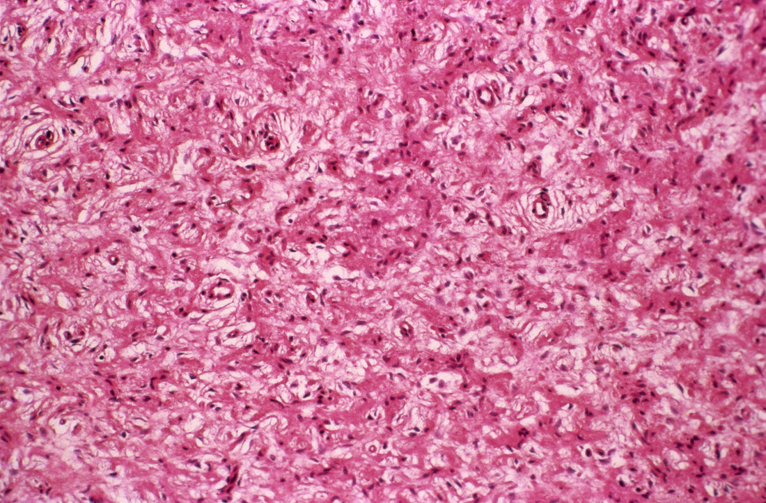 Neurofibroma tumour