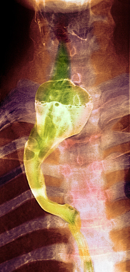 Neurofibromatosis affecting swallowing