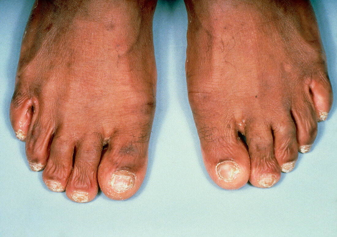 Onychomycosis,a fungal infection of toes & nails