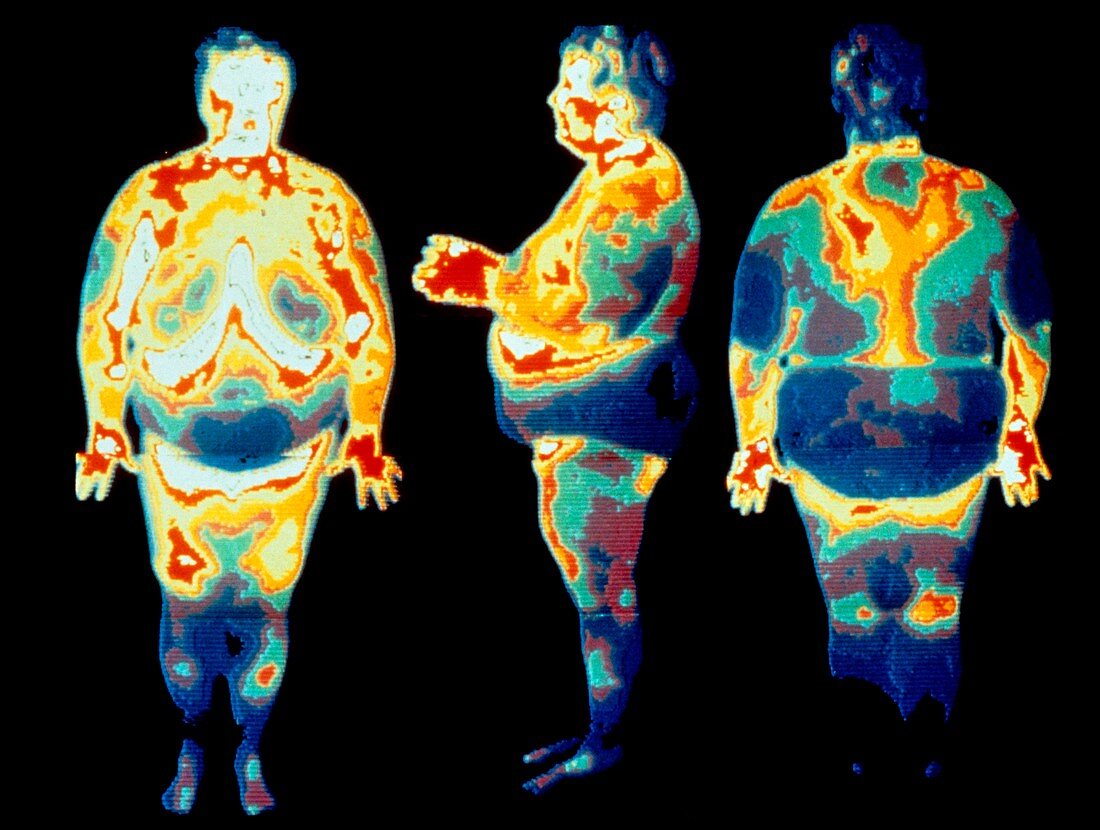 Three thermograms of an obese woman