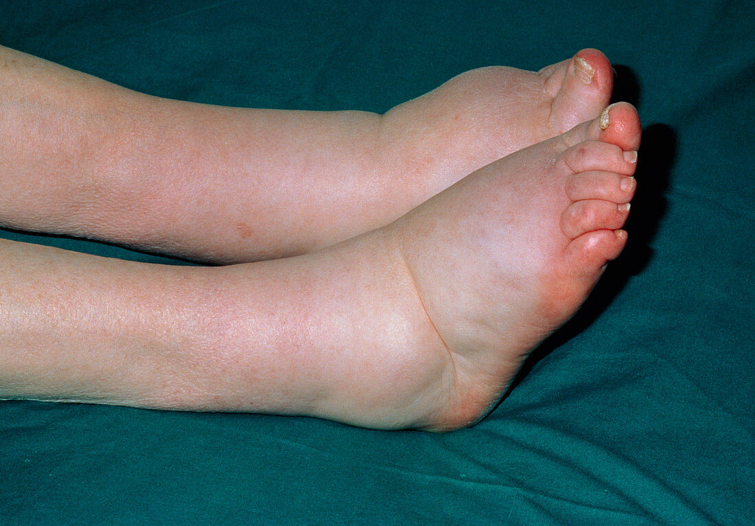 Close up of bilateral ankle swelling