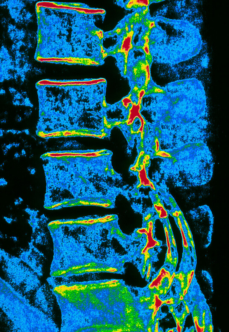 Coloured X-ray of vertebrae with osteoporosis