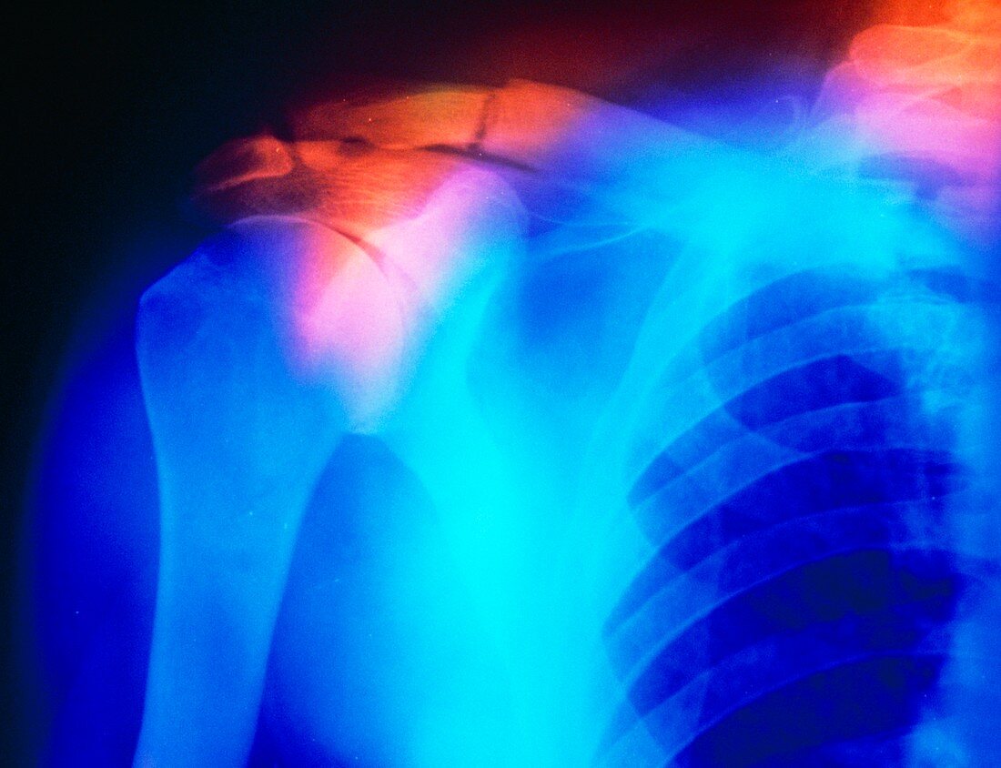 X-ray showing fractured clavicle (paget's disease)