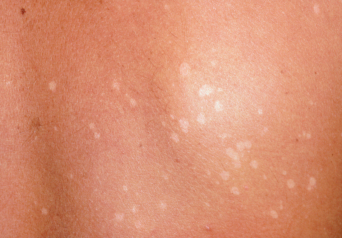 Pityriasis versicolor: light patches on skin