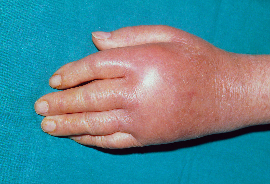 Hand affected by pseudogout