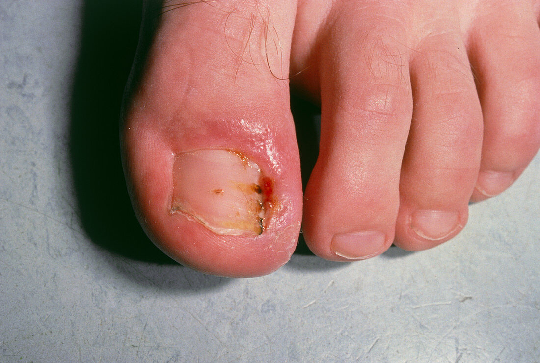 Close up: ingrowing big toenail with paronychia